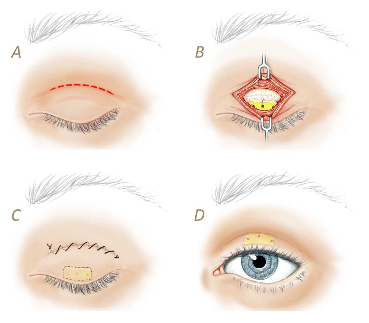 how does facial paralysis affect the eyes