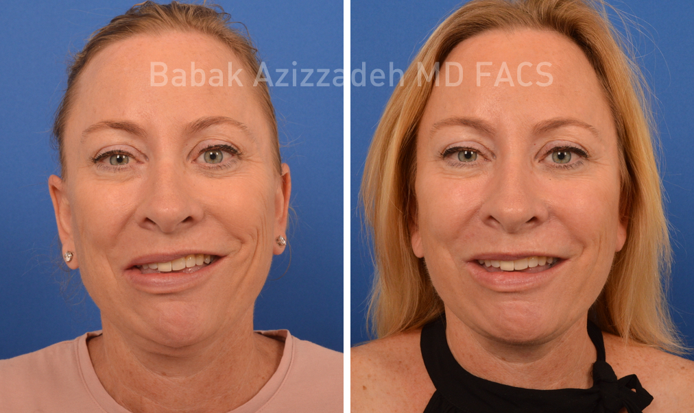 woman before and after selective neurolysis surgery
