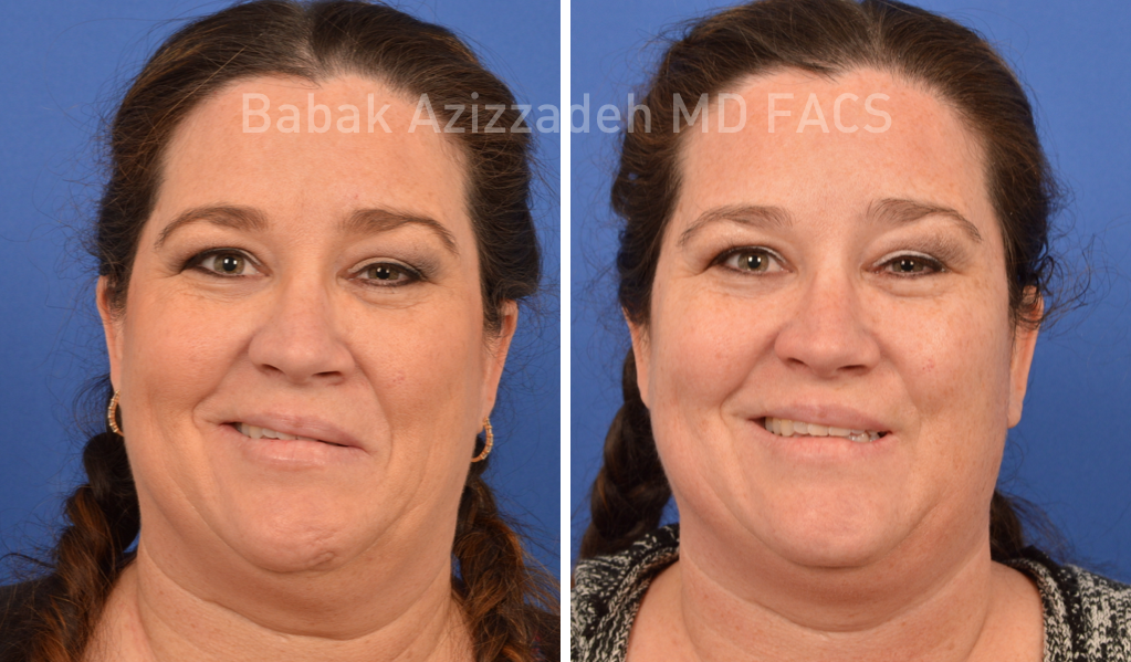 female patient before and 8 days after selective neurolysis surgery