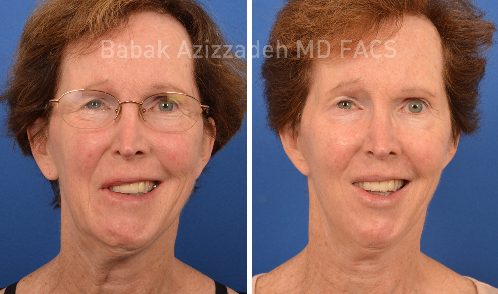 eldery woman before and after selective neurolysis