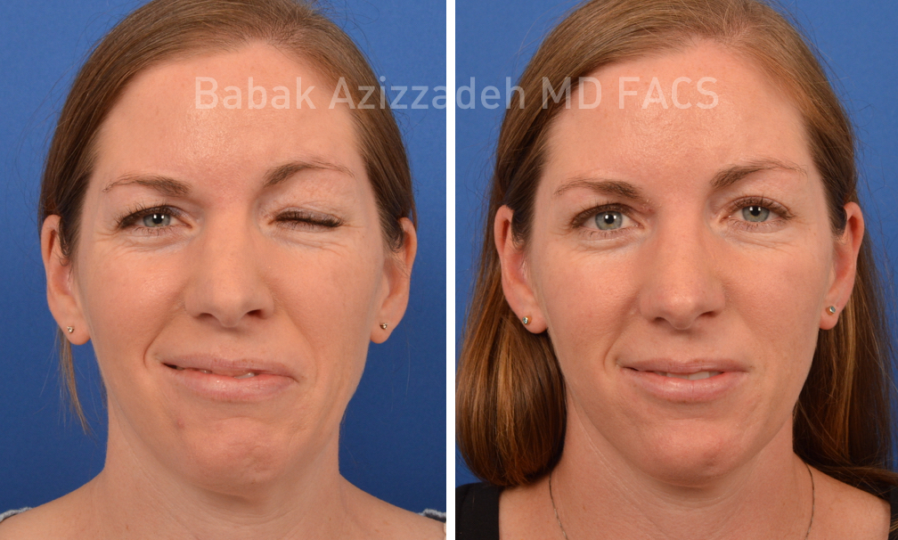 female patient before and after facial paralysis synkinesis treatment