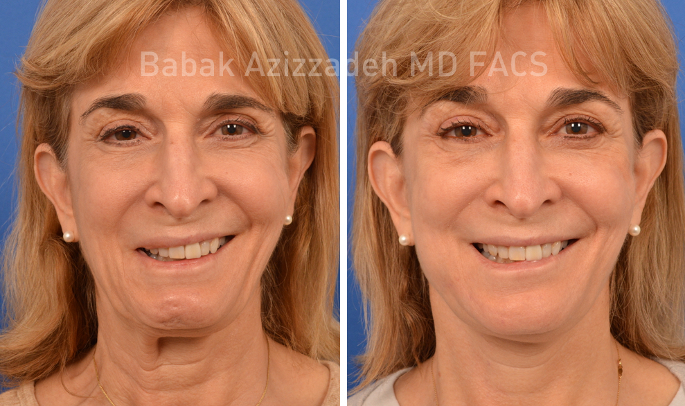 middle age woman before and after selective neurolysis plastysma facial rejuvenation