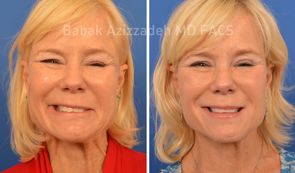 woman before and after selective neurolysis plastysma facial rejuvenation