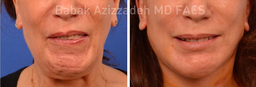 woman before and after selective neurolysis treatment