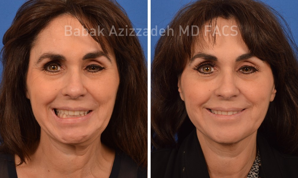 woman before and 3 months after bell's palsy treatment
