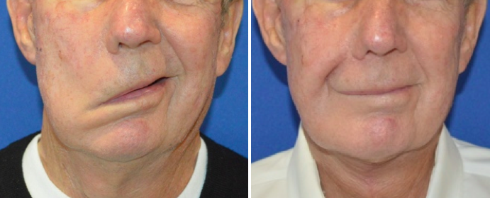 a male patient before and after temporalis tendon transfer