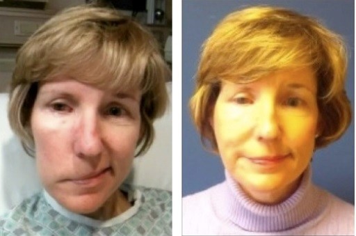 woman before and after facial paralysis surgery