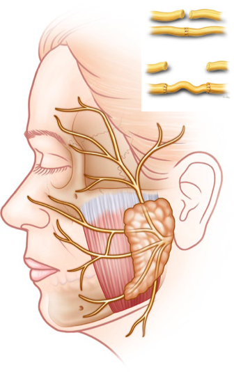Facial paralysis surgery nerve graft