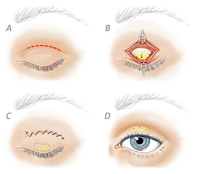 Gold or Platinum Eyelid Weight to Treat Incomplete Eye Closure in Facial  Paralysis 