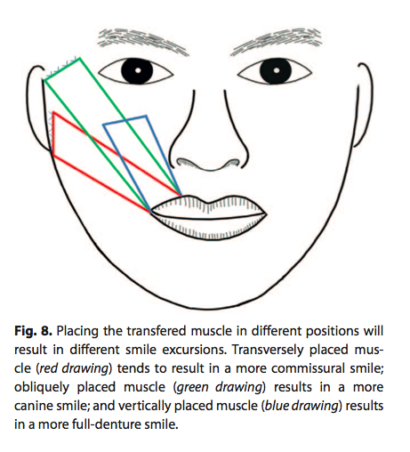 Illustration showing how the arteries and veins of the gracilis muscle should be sewn correctly to the facial arteries and veins during the second stage of facial paralysis reconstruction.