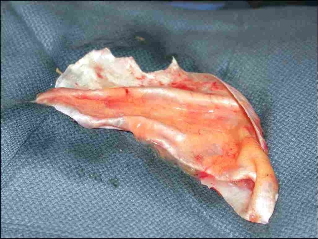 Fascia Tensor Fascia Lata: The Gold Standard Material