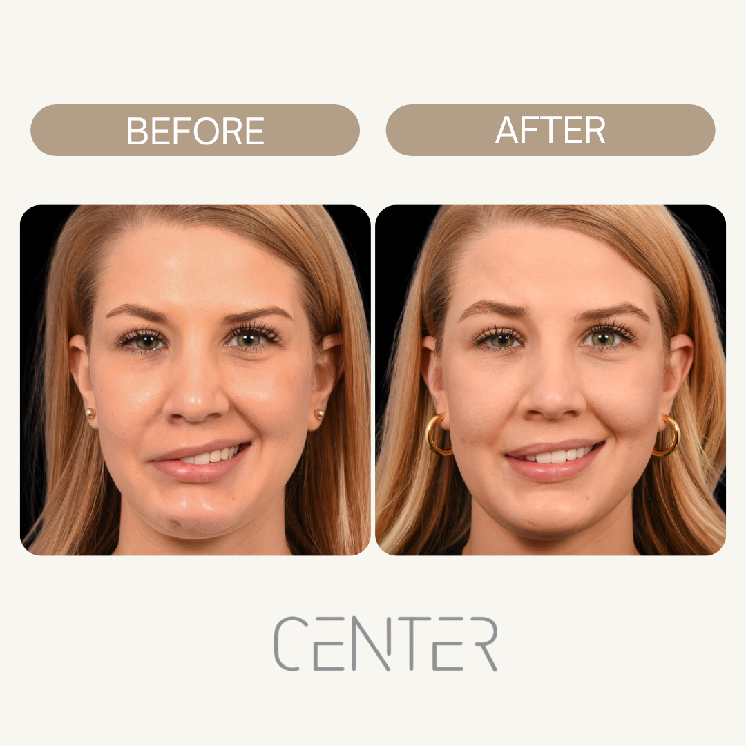 Bell's Palsy Urgery before and after