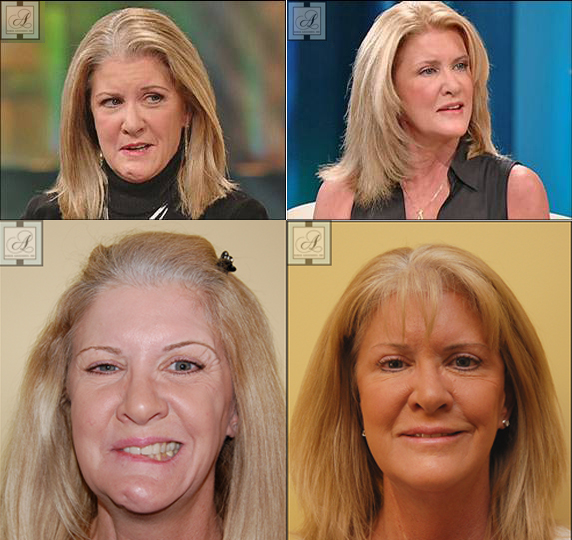 Mary Jo Buttafuoco before and after facelift for synkinesis treatment