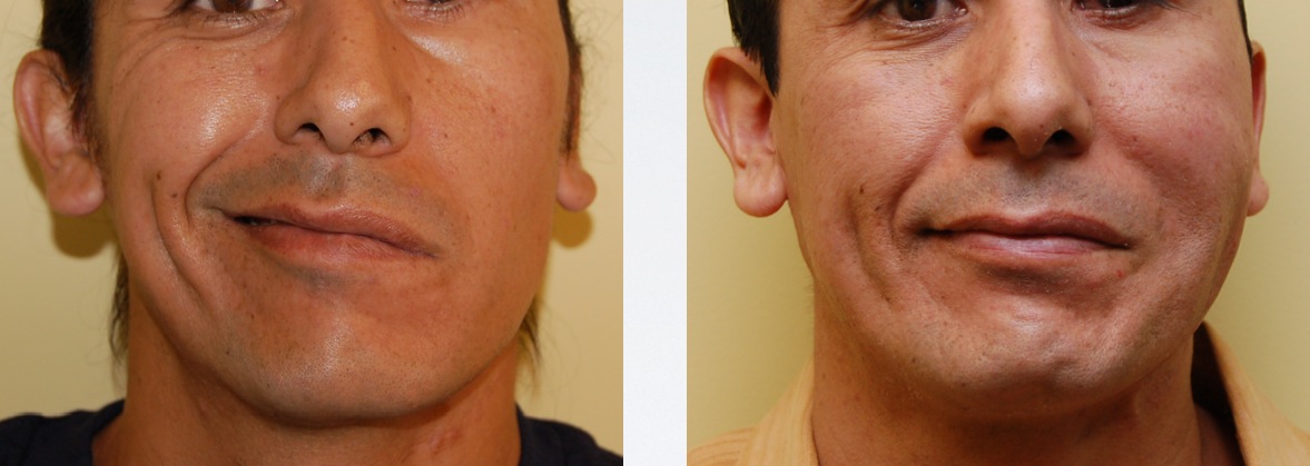 Overcoming the Effects of Facial Paralysis