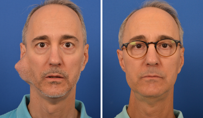 partoidectomy before and after treatment