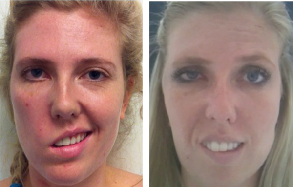 Revolutionary Facial Paralysis Treatments Offered At The Facial Paralysis Institute