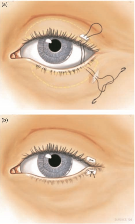 Incised eyelid margins