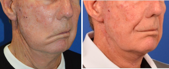 a profile of a male patient before and after temporalis tendon transfer