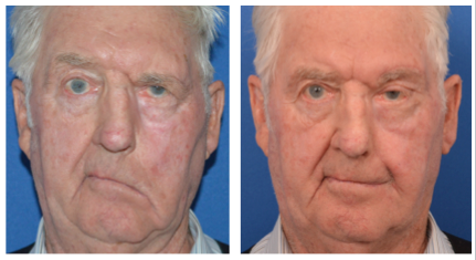 elldery male patient before and after temporalis tendor transfer