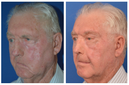 male patient before and after temporalis tendor transfer
