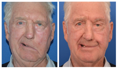an eldery male patient before and after temporalis tendon transfer