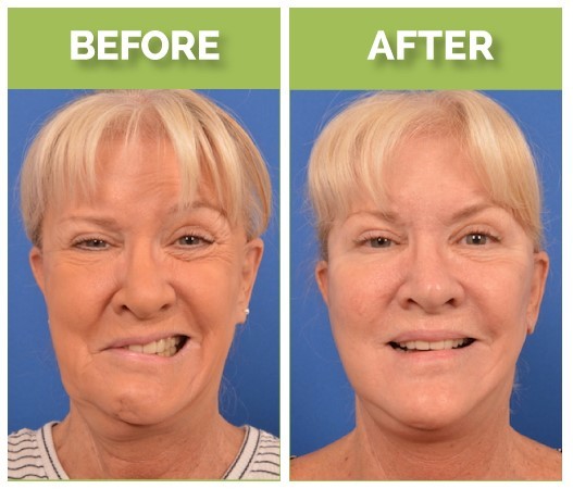 Mary Jo Buttafuoco Facial Reanimation Surgery