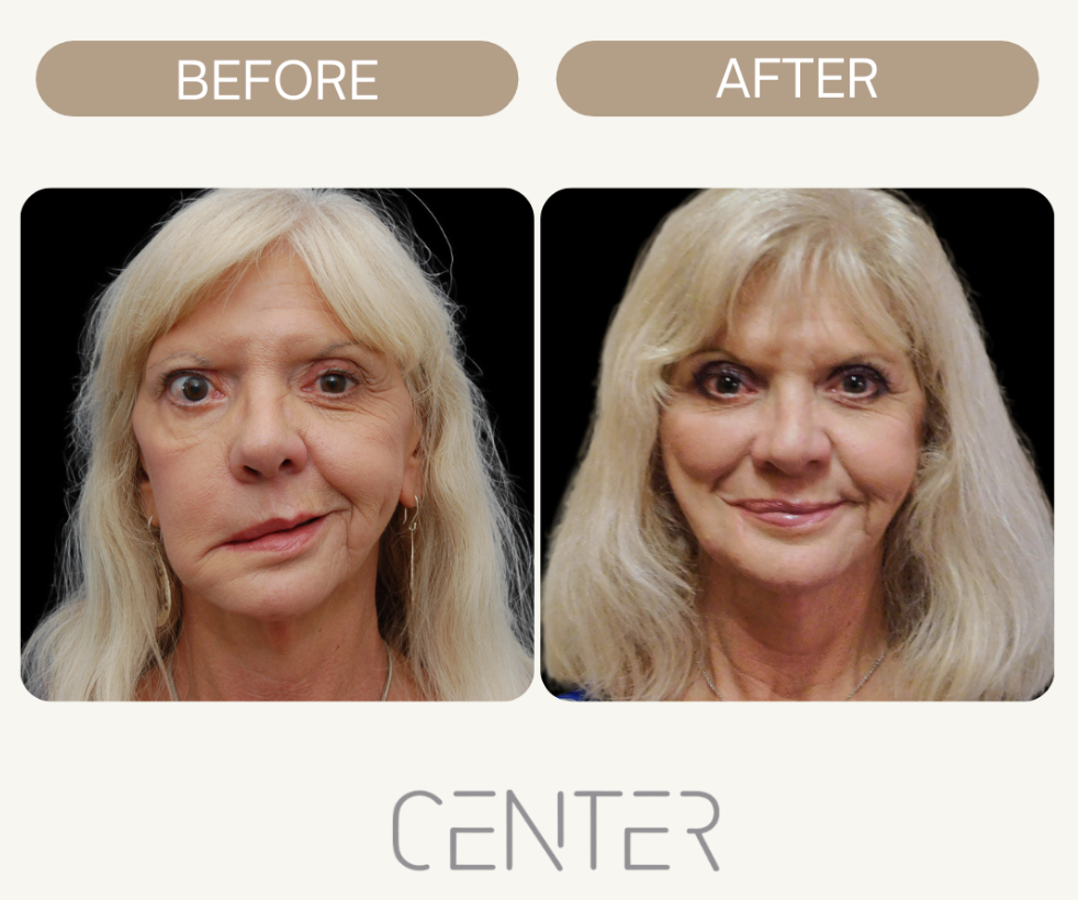 Facial Reanimation by Dr. Azizzadeh