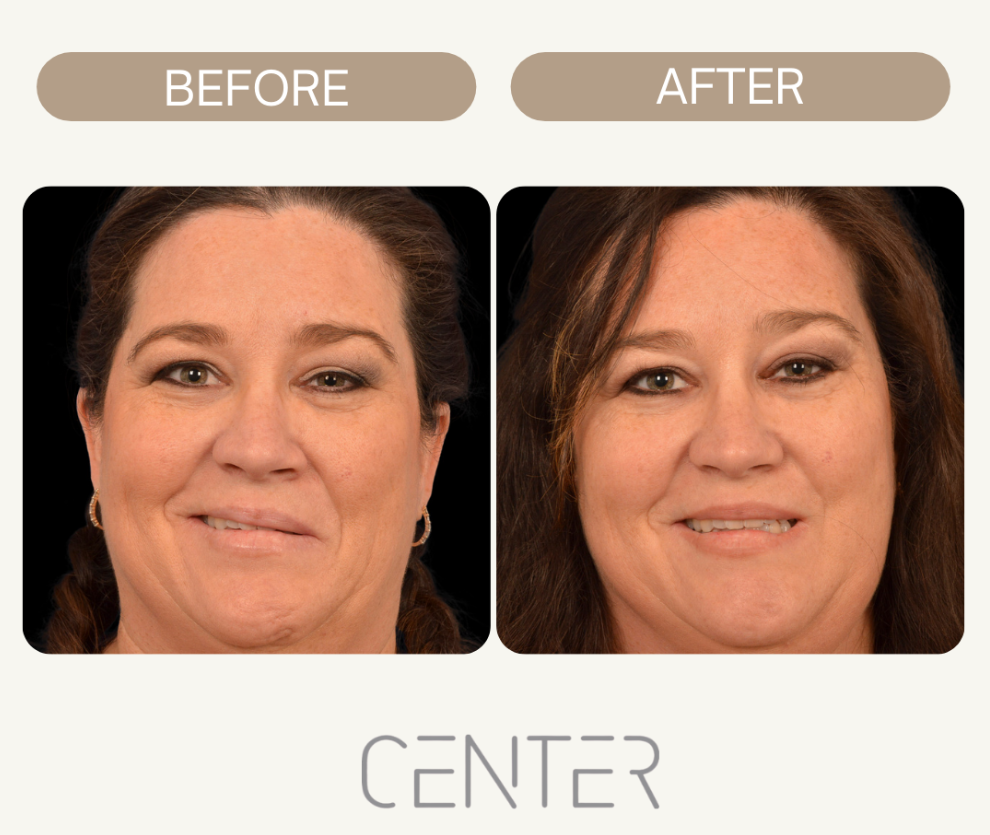 Before and After Facial Reanimation