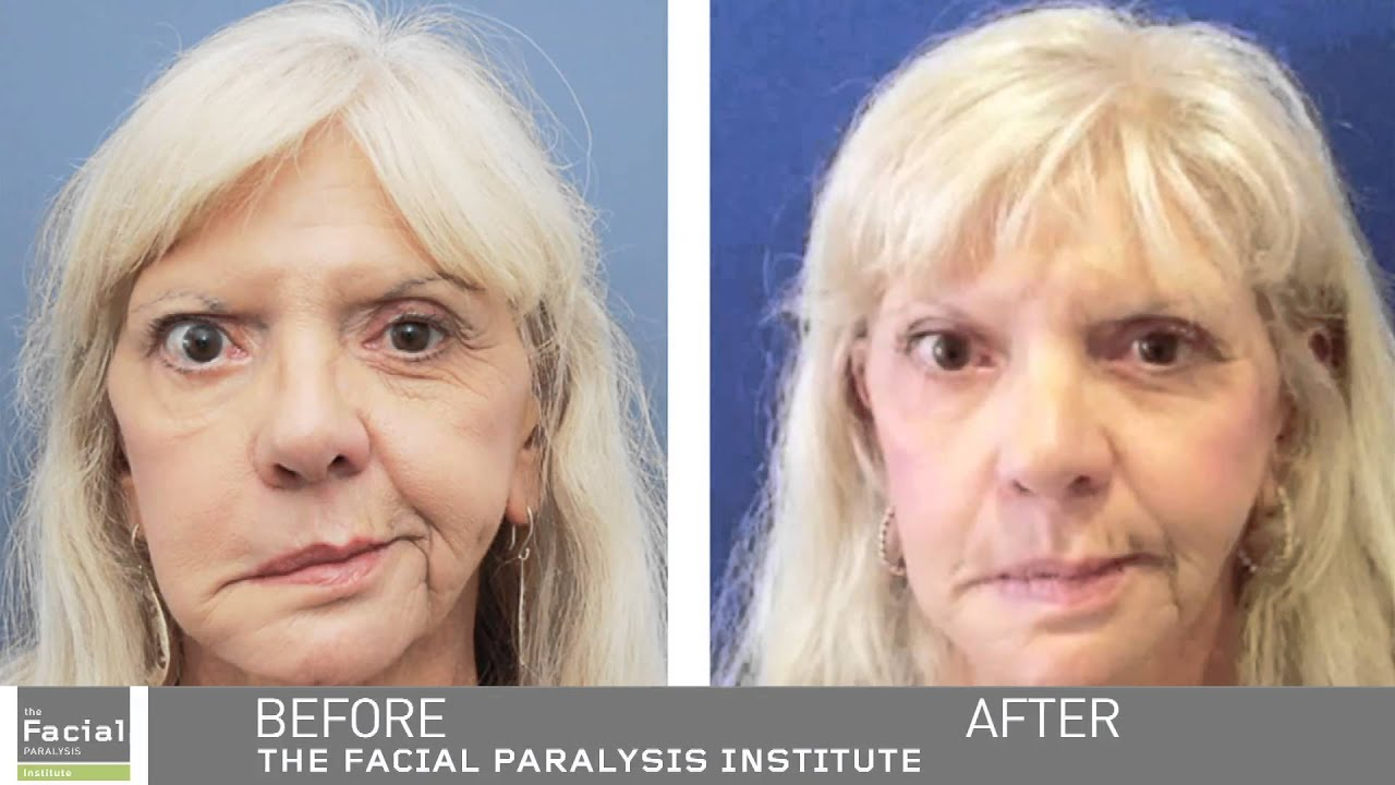 eye reconstruction before and after photo