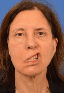 Dual innervated gracilis by cross facial nerve graft and masseteric-facial nerve transfer Before Watermarked