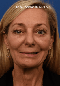 Selective neurolysis, facial rejuvenation and lower blepharoplasty After Watermarked