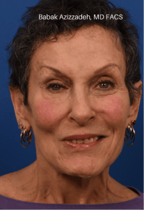 Selective neurolysis with facial rejuvenation After Watermarked