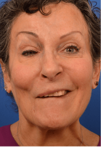Selective neurolysis with facial rejuvenation before Watermarked