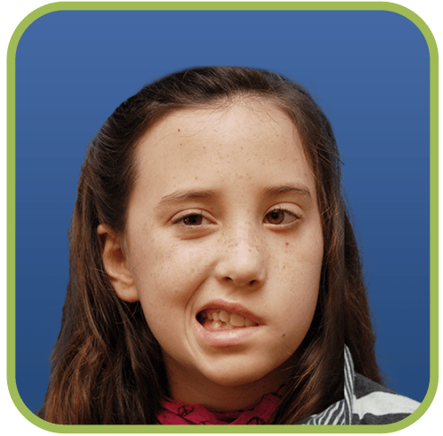 A young girl with Congenital Facial Paralysis