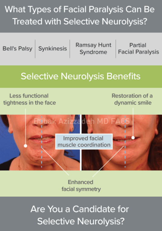 facial nerve mis-wiring synkinesis diagram