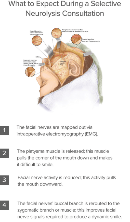 platysma muscle release selective neurolysis