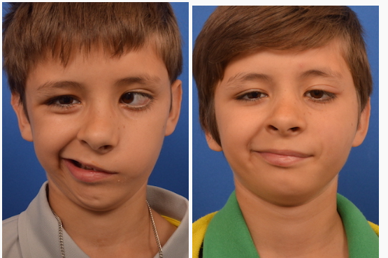child with congenital facial palsy