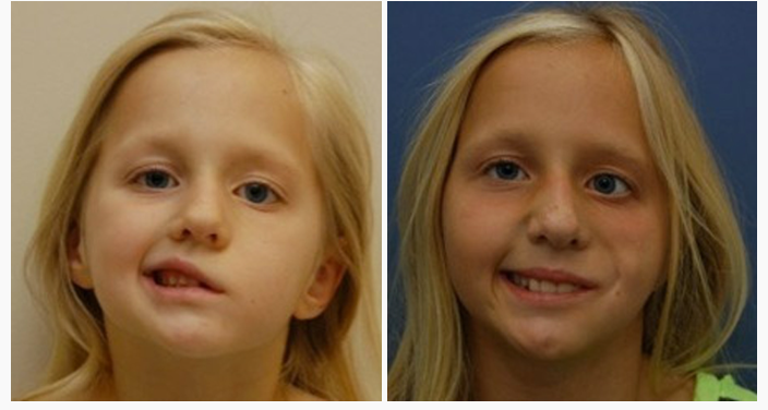 Child with congenital facial palsy before and after