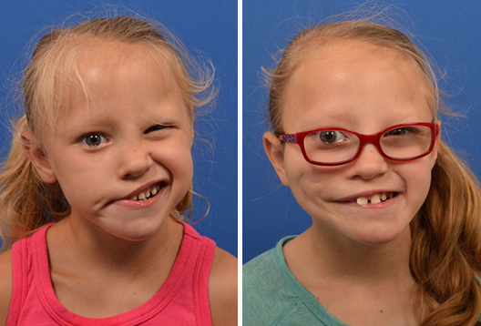 child with Congenital Facial Nerve Palsy 