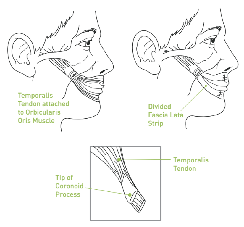 Muscle Transposition Techniques for Facial Reanimation