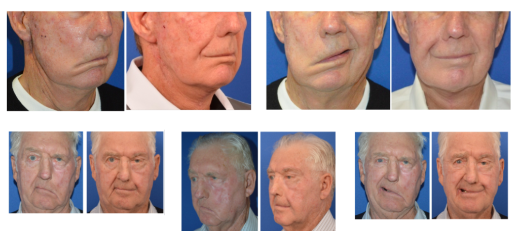 images of before and after surgery