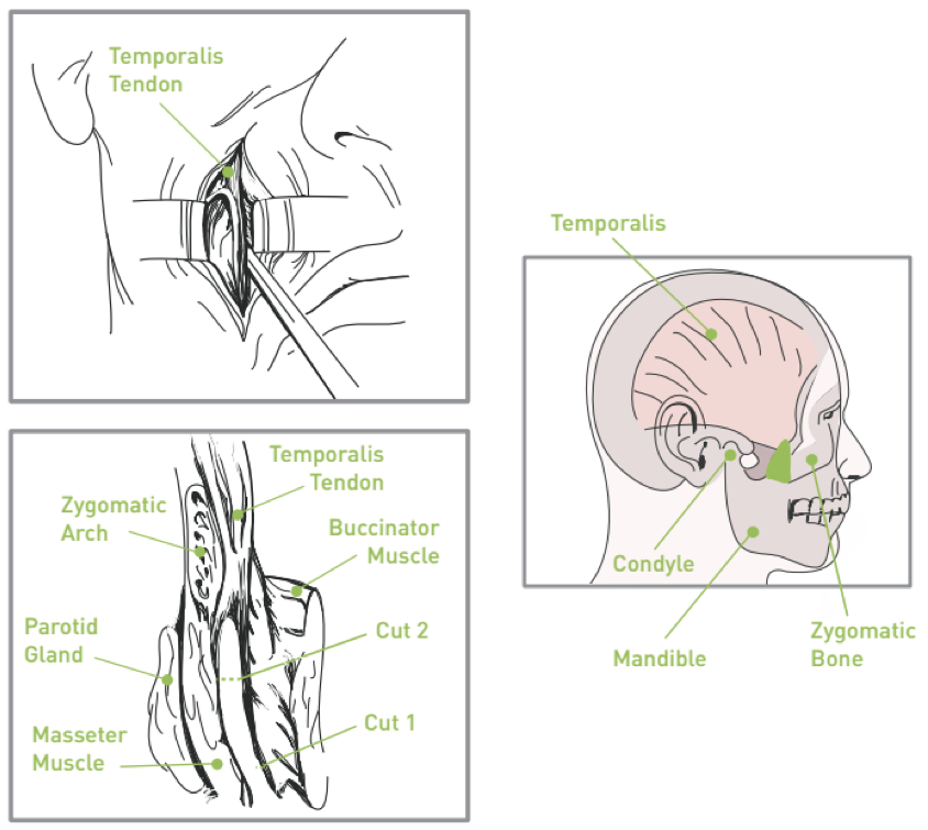 Key benefits of temporalis tendon transfer surgery