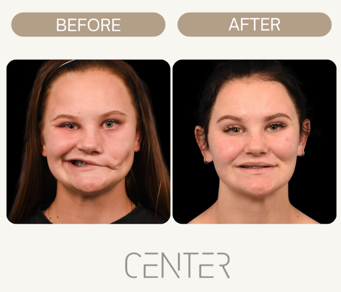 Bell's palsy patient before and after treatment