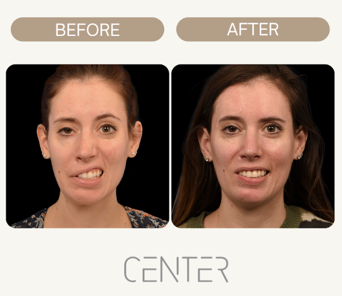 Bell's palsy patient before and after treatment