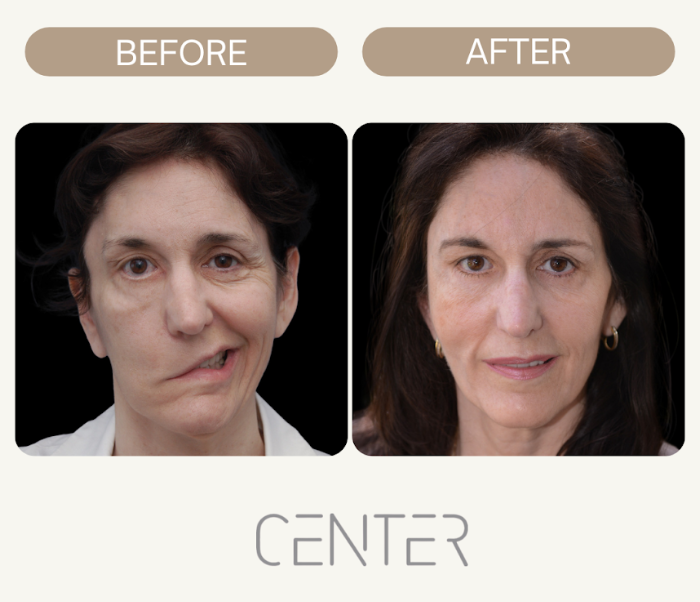 Bell's palsy patient before and after treatment