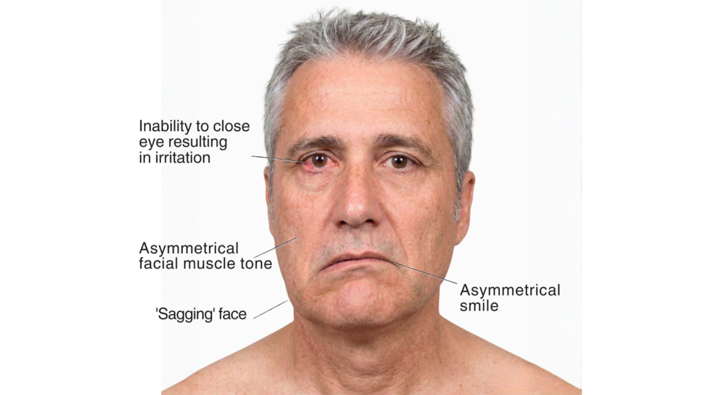 man with bell’s palsy