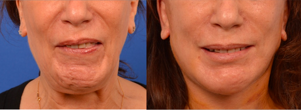 woman with slight facial nerve damage
