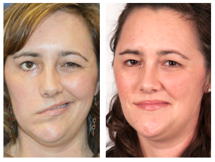 facial nerve paralysis example