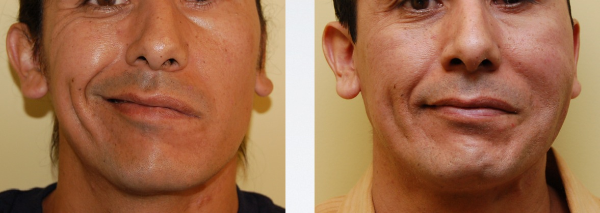 man with bells palsy