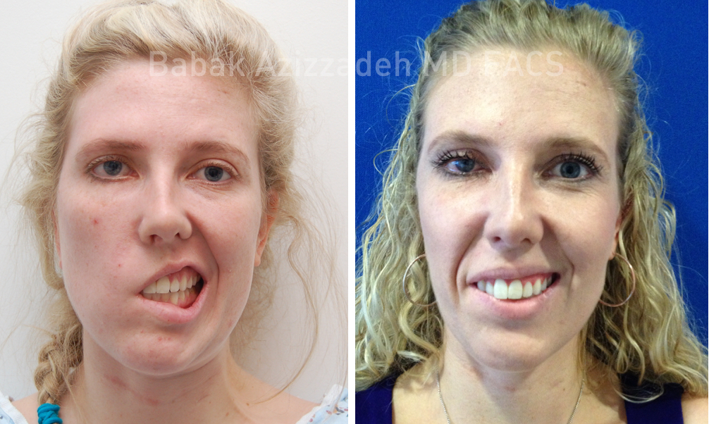woman showing facial nerve damage